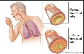 Symptoms of respiratory illness		